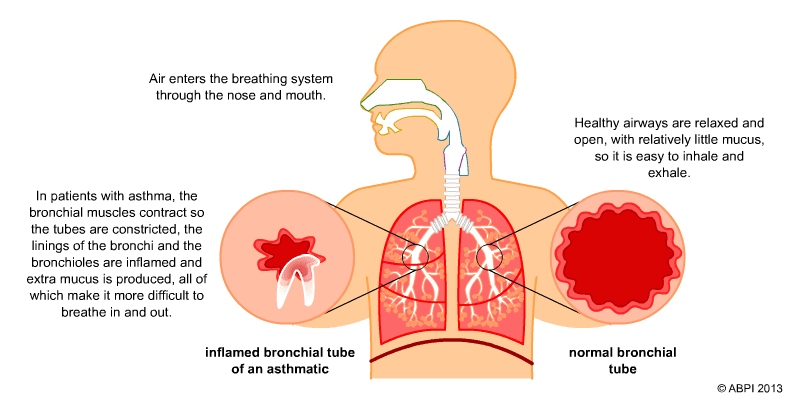 Asthma & Respiratory Care