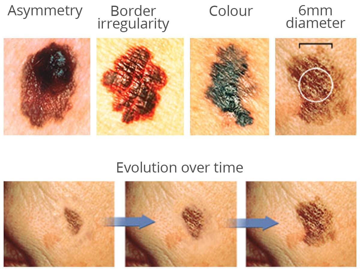 Skin Cancer Screening